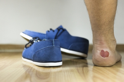 Causes and Prevention of Blisters From Running