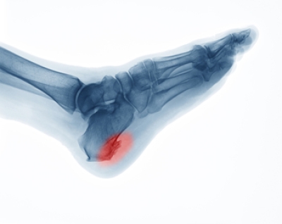 What Causes Heel Spurs?